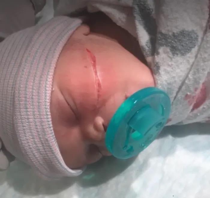NEWBORN’S FACE CUT IN BOTCHED C-SECTION
